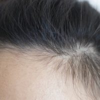 女性の薄毛は側頭部に起こりやすい？